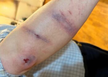 ניו יורק: חסיד כבן 50 נשדד והוכה קשות