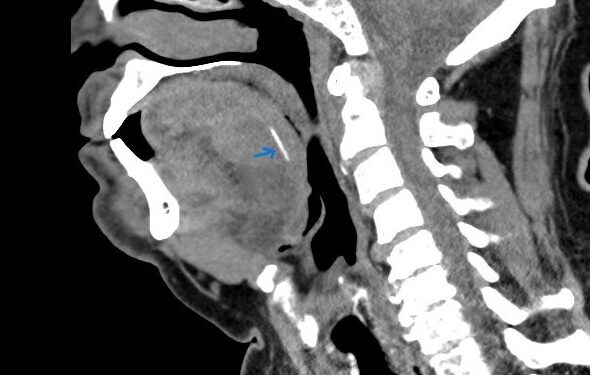 צפת: עצם דג באורך שני ס”מ נשלפה מלשונו של מטופל
