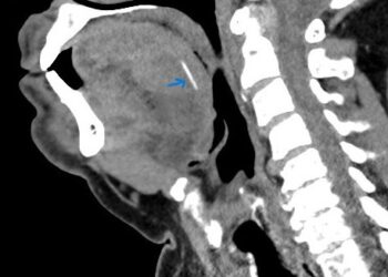 צפת: עצם דג באורך שני ס”מ נשלפה מלשונו של מטופל